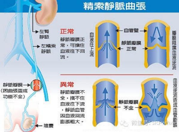 關(guān)于2021年征兵精索靜脈曲張標(biāo)準(zhǔn)的探討，2021年征兵精索靜脈曲張標(biāo)準(zhǔn)深度解析