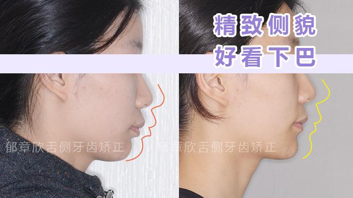 下巴后縮矯正方法詳解，下巴后縮矯正方法全面解析