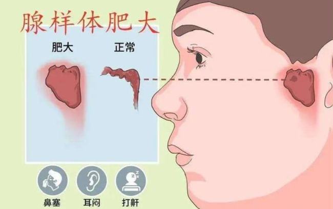 腺樣體肥大能自愈嗎？——深度解析與理解，腺樣體肥大能否自愈？全面深度解析