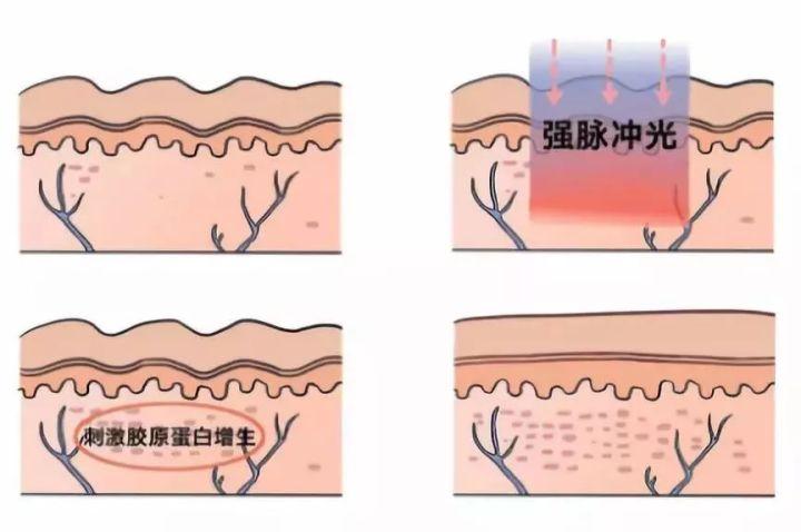 簡單有效的痘坑修復(fù)方法，讓你的肌膚重拾光彩，簡單有效的痘坑修復(fù)秘訣，重塑肌膚光彩！