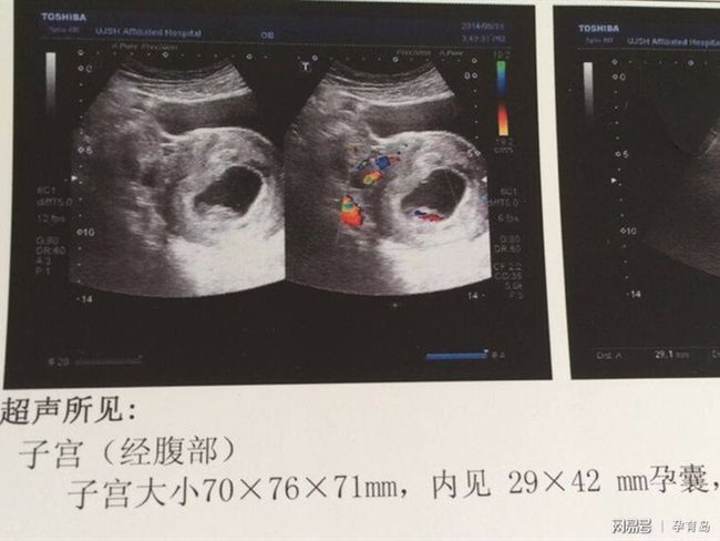 有卵黃囊基本就穩(wěn)了，早期妊娠的穩(wěn)固跡象與注意事項(xiàng)，早期妊娠的穩(wěn)固跡象，卵黃囊出現(xiàn)后的穩(wěn)定與注意事項(xiàng)