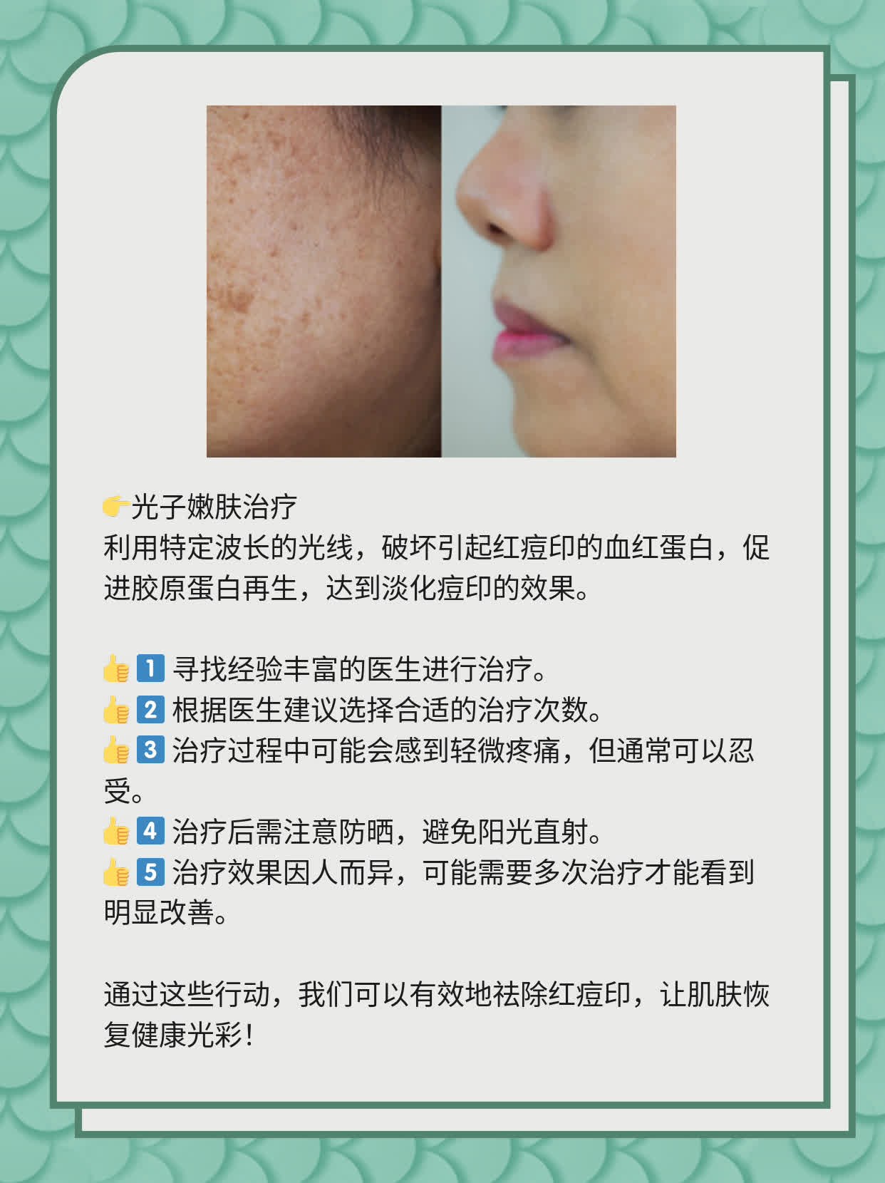 如何有效去除紅痘印，一站式解決方案，一站式解決紅痘印問題，有效去除方法大全