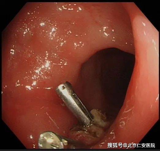 胃腸鏡檢查后悔死了？了解真相，消除疑慮，揭秘胃腸鏡檢查真相，消除疑慮，避免后悔！
