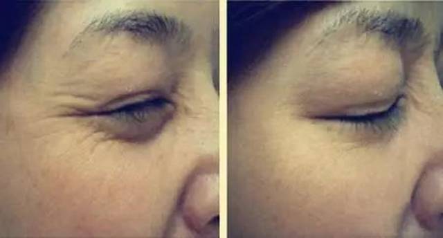 肉毒素除皺的副作用深度解析，肉毒素除皺副作用深度解析