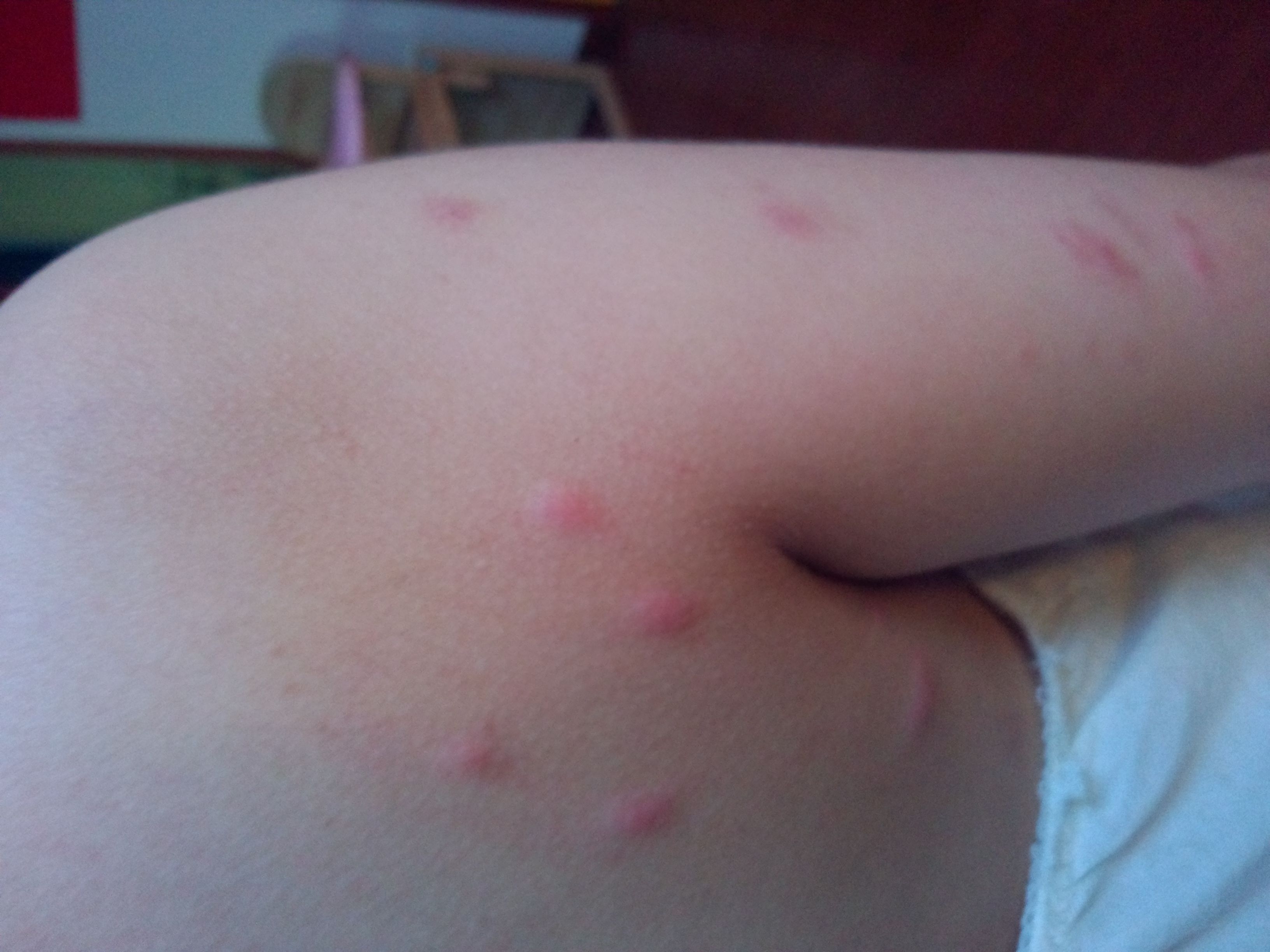 身上紅疙瘩圖片對照，了解皮膚問題的真相，身上紅疙瘩圖片對照，揭示皮膚問題真相