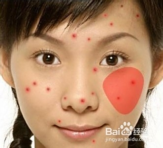 青春期長痘痘了怎么消除，全面解析與應(yīng)對方法，青春期痘痘消除全面解析與應(yīng)對方法指南