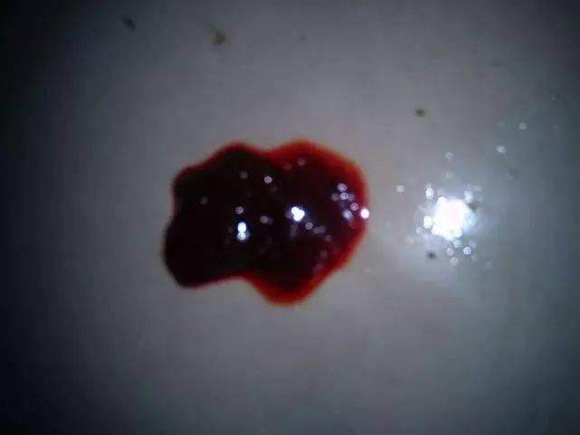 排便時出現(xiàn)撕裂感及出血，原因與應對措施，排便疼痛撕裂感及出血，原因分析及應對方法