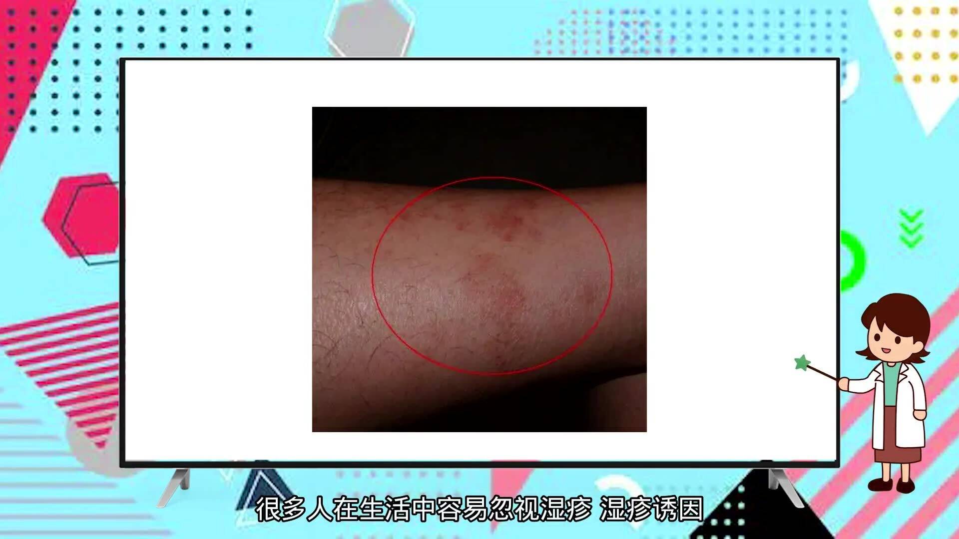 蕁麻疹夜晚止癢妙招，讓你遠(yuǎn)離瘙癢困擾，蕁麻疹夜晚止癢小妙招，告別瘙癢煩惱