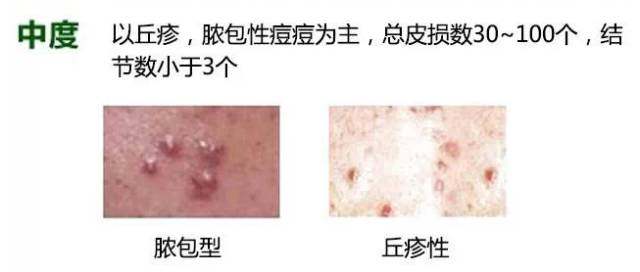 白頭粉刺圖片，了解、預(yù)防與應(yīng)對(duì)，白頭粉刺詳解，圖片、預(yù)防與應(yīng)對(duì)策略