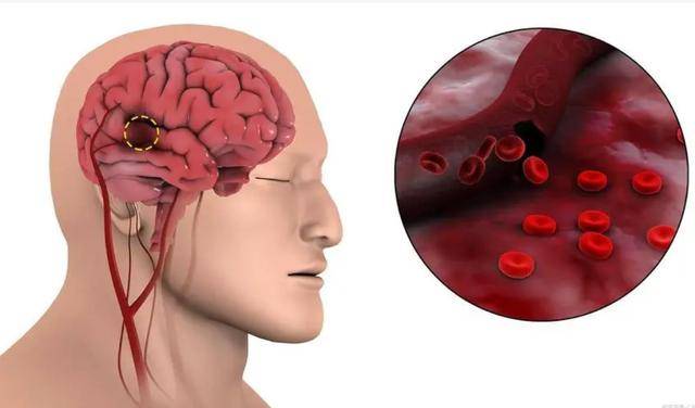 如何判斷自己是否腦供血不足——癥狀解析與應對策略，腦供血不足的判斷方法，癥狀解析及應對之策